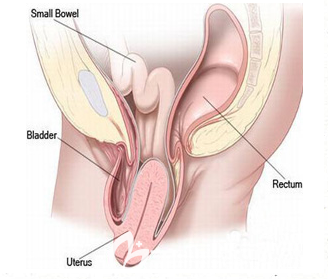 子宫下垂矫正手术