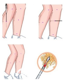 小腿吸脂的案例