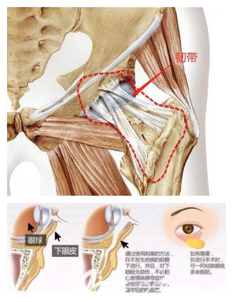 印第安纹剥离手术适合程度较重的人群