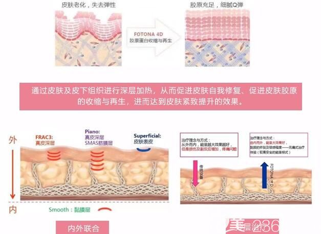 fotona 4d抗衰技术原理示意图