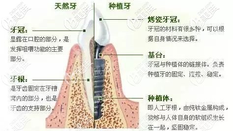 种植牙的示意图