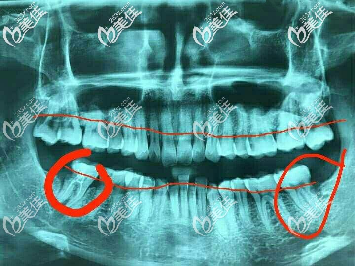 牙齿片子怎么看图片