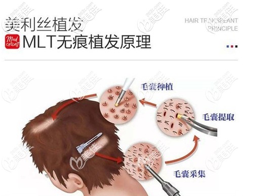 瑞丽MLT无痕植发原理