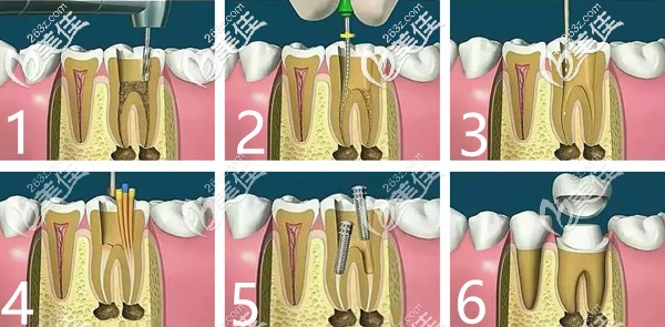 根管治疗的过程图解