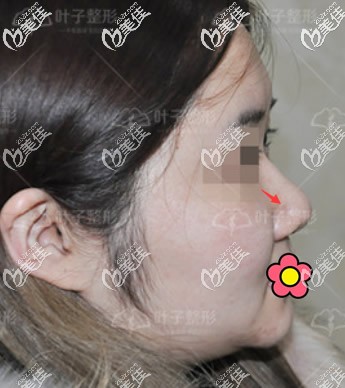 硅胶取出鼻子变化图片图片