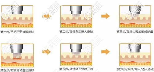 微针去痘坑的作用