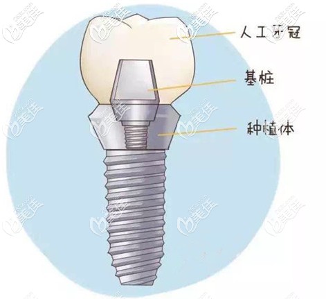 为啥医生建议做种植牙