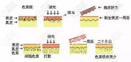 激光祛雀斑原理