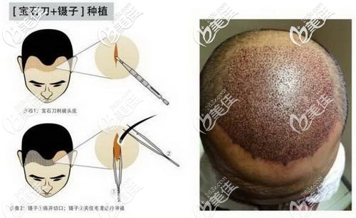 fue无痕植发是用微针还是宝石刀?