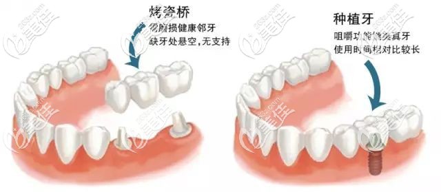 种植牙与烤瓷牙的区别是什么