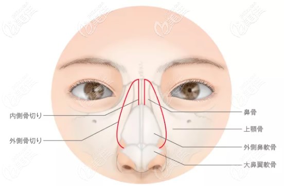 听说宽鼻缩窄就是鼻骨内推 请问鼻梁截骨内推的优缺点有哪些 鼻部修复 美佳网整形问答