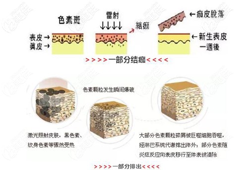 激光祛斑原理