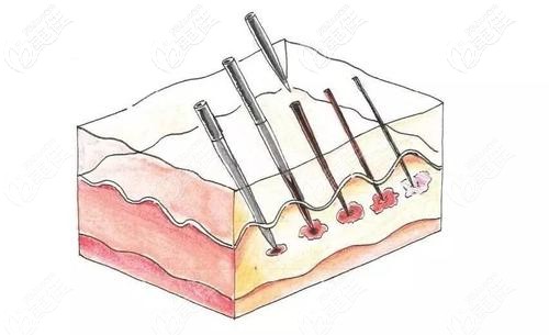 微针治疗黄褐斑