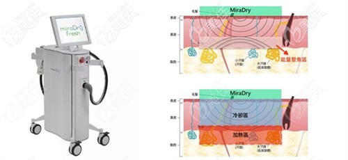 miradry治疗腋臭原理