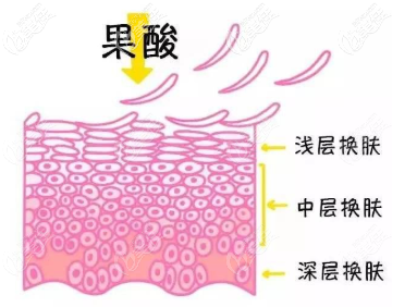 果酸换肤原理