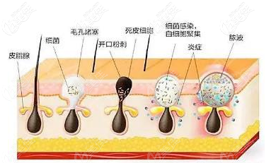 果酸换肤