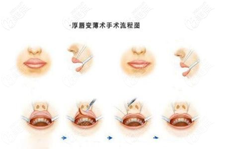 厚唇改薄术过程