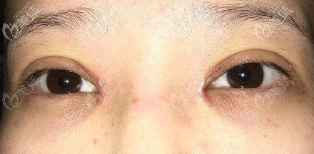 开眼角一个月缝合处有白色疤痕凸起后期恢复会消变平整吗