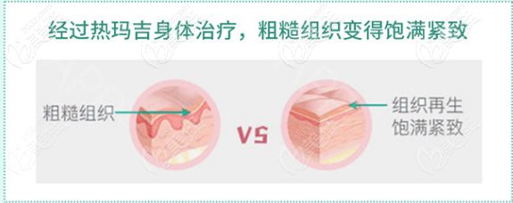 热玛吉治疗去除妊娠纹的效果示意图