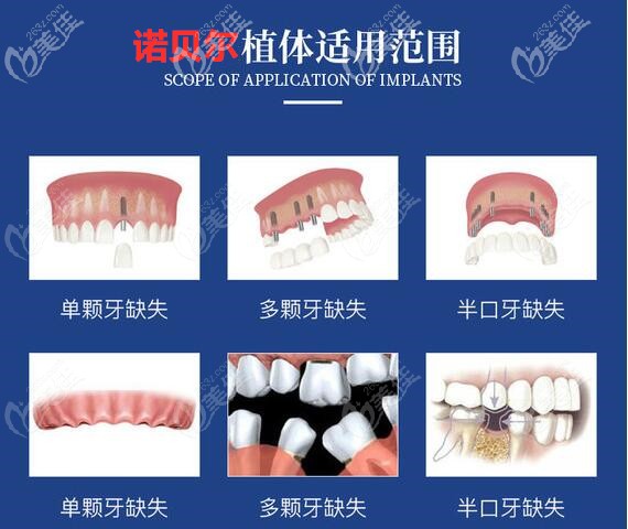 瑞典诺贝尔种植牙的适用范围