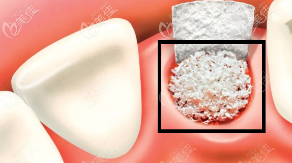 種牙用的骨粉是什麼東西醫生建議我媽做種植牙要填骨粉到底有沒有必要