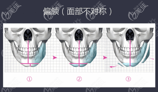 骨性偏颌建议正颌或者正畸正颌联合手术矫正