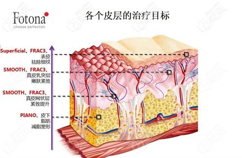 fotona4D治疗层次