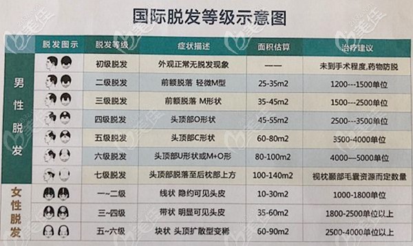 男性脱发一般分为7个等级,不同的脱发级别对应建议种植的毛囊单位个数