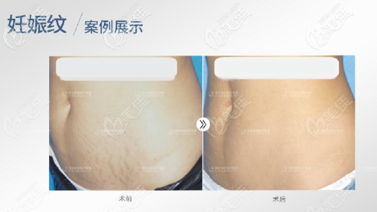 胸前疤痕疙瘩8年了，在重庆郑荃丽格治疗花掉三万多块钱
