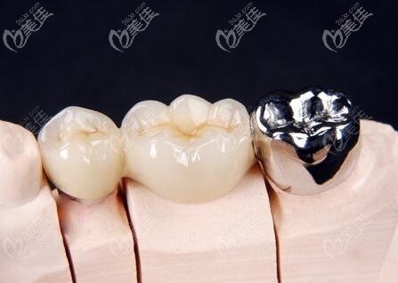 纯钛聚合瓷和全瓷牙哪个好?哪种牙冠的价格更划算