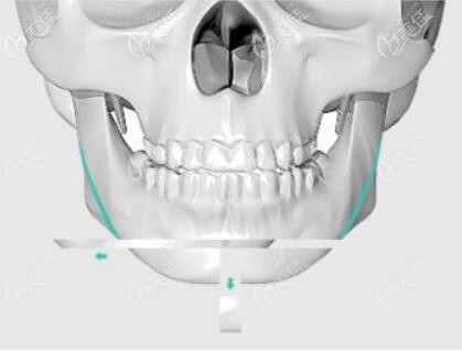 下巴t型截骨手术图解过程示意图