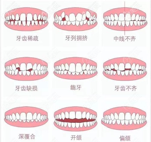 维乐口腔牙齿正畸类型