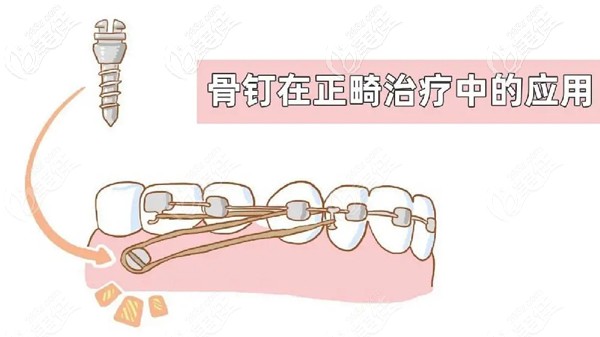 正畸打骨钉疼吗龅牙矫正打骨钉的话一般得戴多久