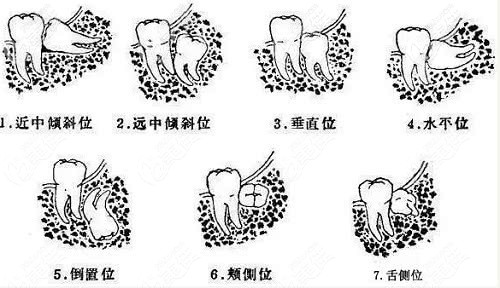 各种位置的智齿