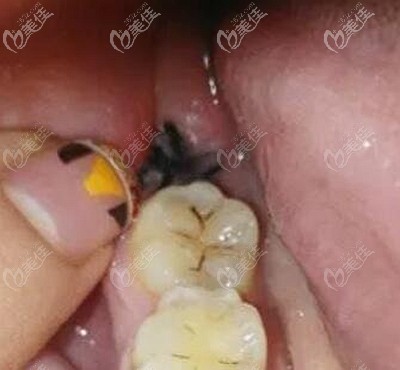 拔牙后得干槽症的牙洞是啥样的是不是灰白色