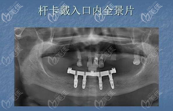 杆卡式覆盖义齿图片