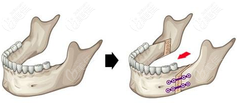 嘴呼吸导致骨性牙齿突出的解决方法