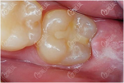四岁牙齿蛀牙有洞补牙选择树脂玻璃离子陶瓷嵌体哪种材料
