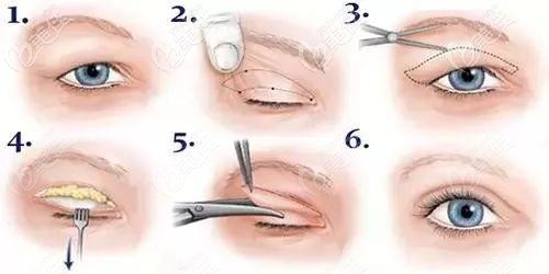 做全切双眼皮后睫毛根部外翻露白是不是去皮太多了怎么修复