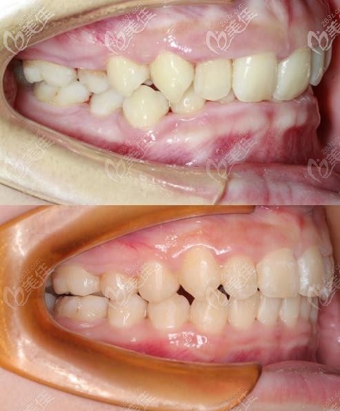 矫正牙齿脸型前后照图片