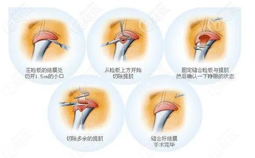 眼睛提肌手術可以單獨做嗎我本身是雙眼皮就是有些提肌無力