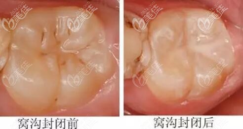 儿童牙窝沟封闭几岁做合适会有什么副作用吗