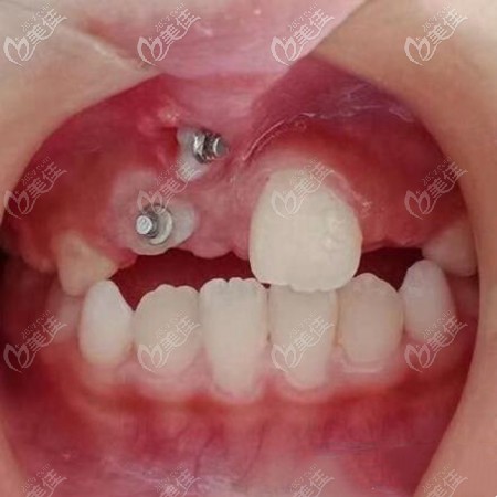 洛阳八岁儿童门牙牵引手术案例,历时18个月牙齿正畸成功