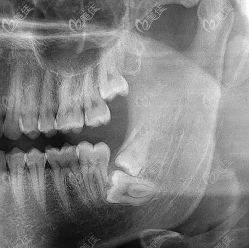 口腔全景片可以了解牙齿的情况