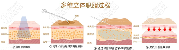 多维立体吸脂手术过程示意图