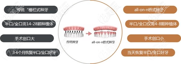 单颗和连桥种植牙的区别