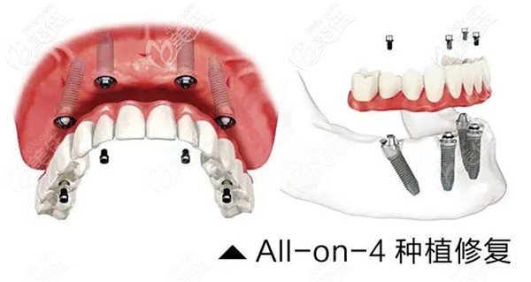 ALL-ON-4数字化即刻负重