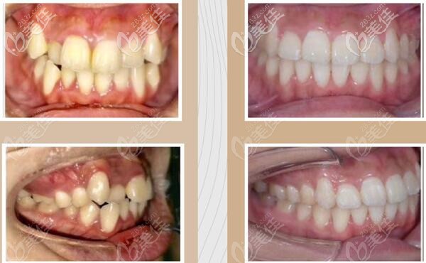 虎牙牙齿矫正对比照片图片