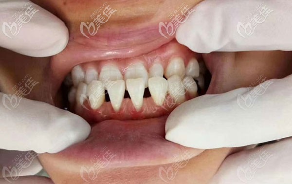 贵州毕节人的牙齿图片图片