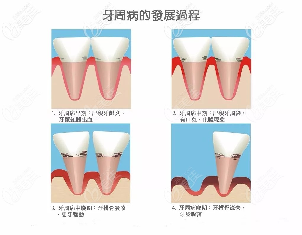 牙周炎发展历程